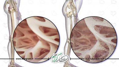روشهای درمان پوکی استخوان و سلامت استخوان در طب سنتی