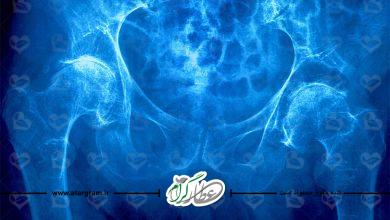 عوامل و فاکتور های خطر در بیماری پوکی استخوان چیست؟