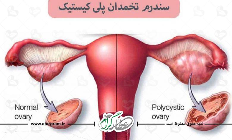 درمان تنبلی تخمدان پلی کیستیک