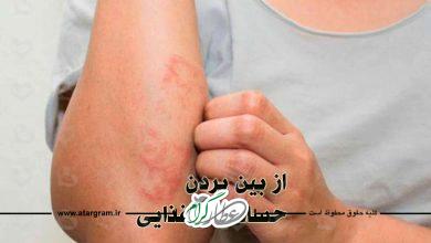 از بین بردن حساسیت غذایی