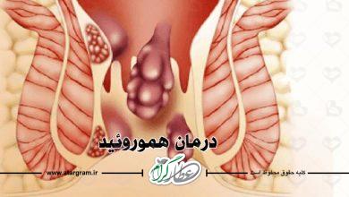 درمان هموروئید
