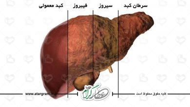 علائم کبد چرب