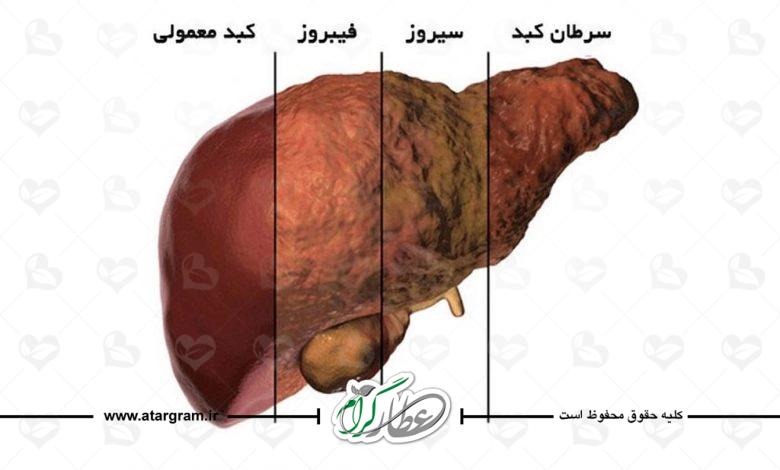 علائم کبد چرب