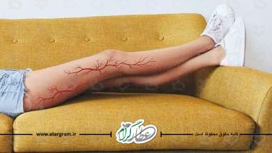 درمان واریس با استفاده از گوجه فرنگی چگونه است؟