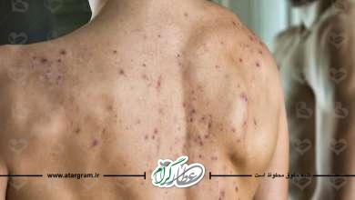 راهکارهایی برای پوستهای مستعد به جوش و آکنه چیست؟