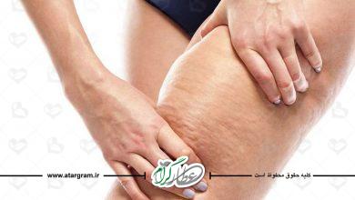 سلولیت چیست