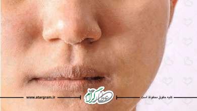دلایل و درمان خشکی و پوسته پوستهشدن اطراف بینی