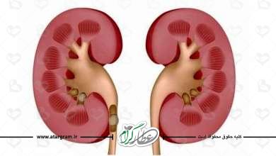 دلایل سنگ ساز شدن کلیه ها و علائم ایم بیماری