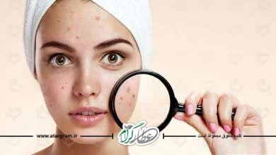 ارتباط میان جوش و رابطه جنسی