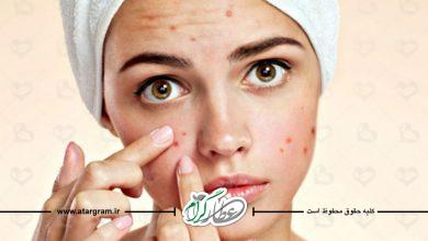 راه های درمان جوش و آکنه