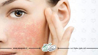 درمان خانگی خشکی پوست در طب سنتی و دلایل و علائم آن