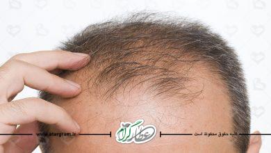 آشنایی با طاسی، ریزش مو و آلوپسی