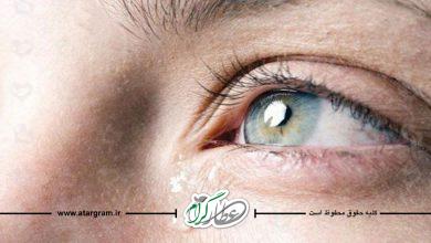 درمان بیماری آبریزش چشم