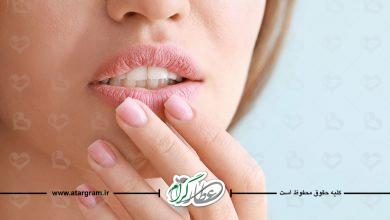 درمان خانگی ترک لب در طب سنتی