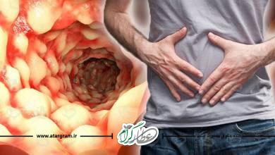 درمان بیماری کرون و التهاب روده در طب سنتی