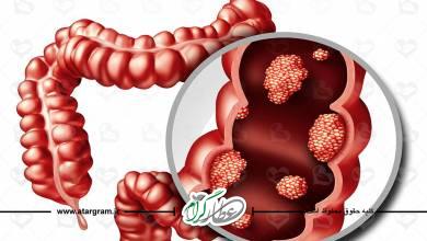 درمان کولیت و التهاب روده در طب سنتی