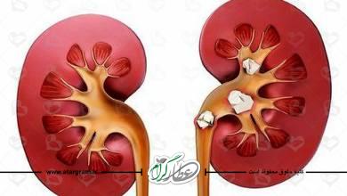 علت و علائم ایجاد سنگ کلیه