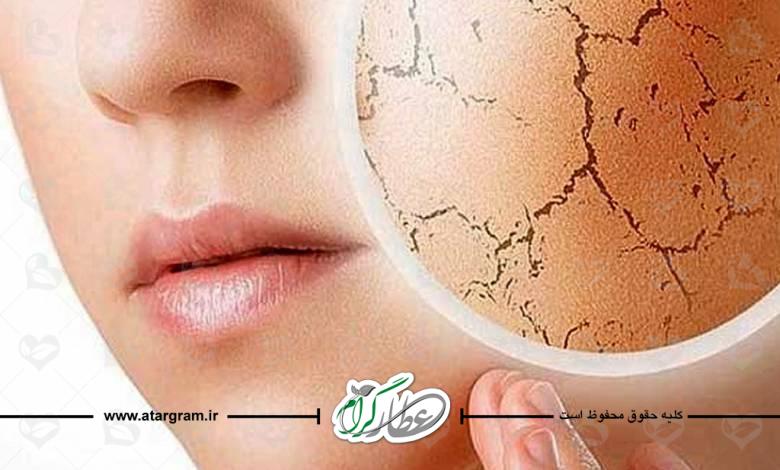علت و دلایل بیماری خشکی پوست در طب سنتی