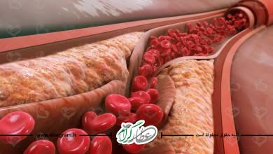 علت افزایش کلسترول و چربی خون