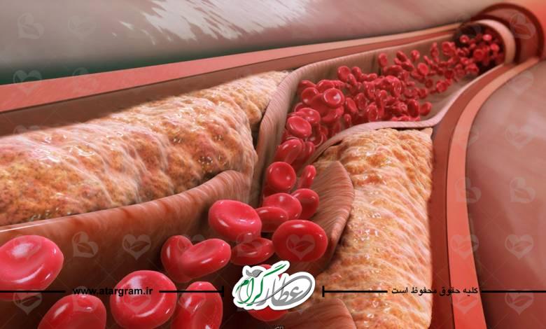 علت افزایش کلسترول و چربی خون