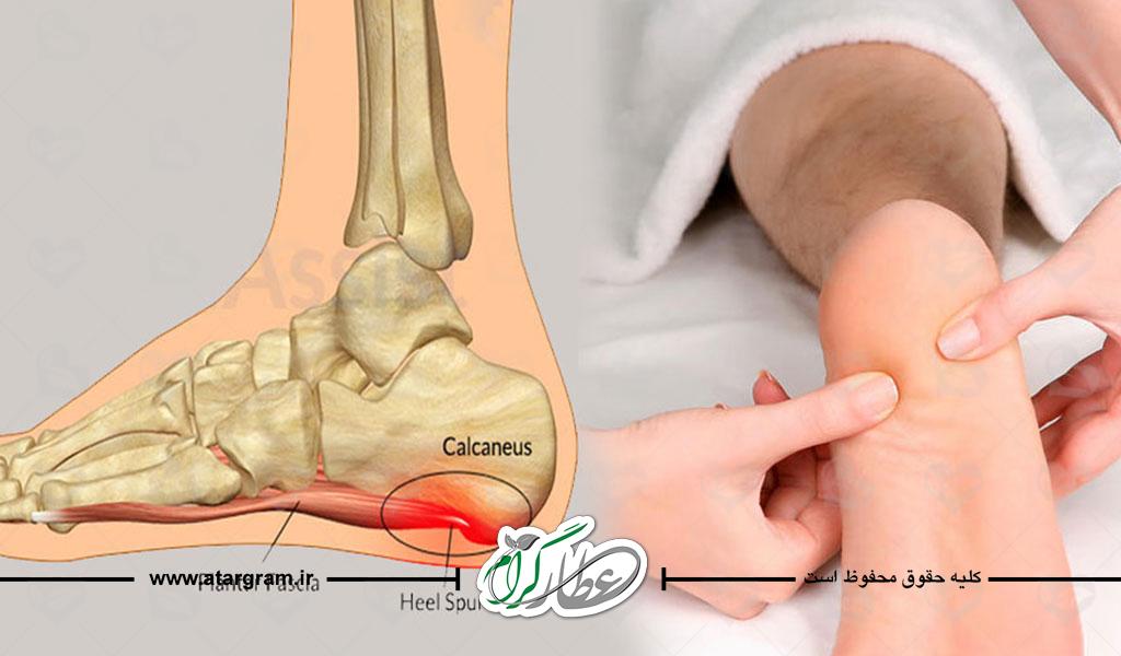 درمان خار پاشنه پا با روش های خانگی طب سنتی و علت و علائم آن
