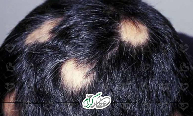 بیماری آلوپسی آره آتا