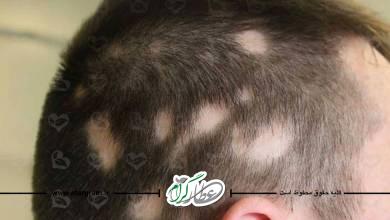 علت و علائم آلوپسی آره آتا