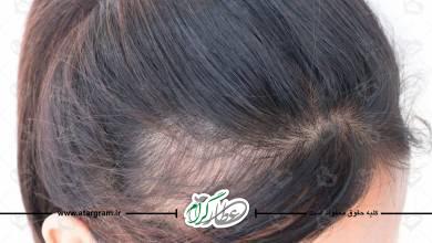 درمان آلوپسیا آره آتا